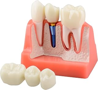 Dental Implant Patient Education Model